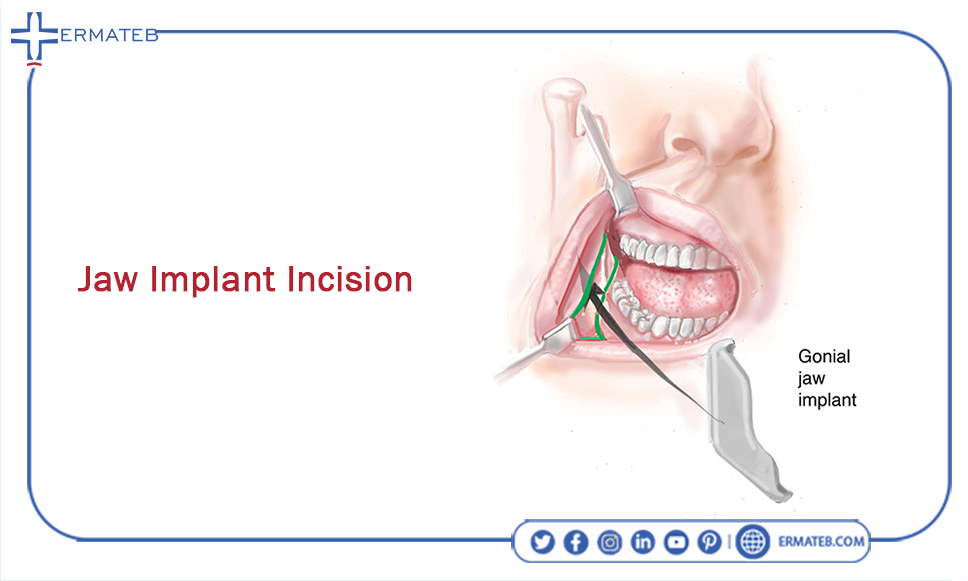 jaw implant incision